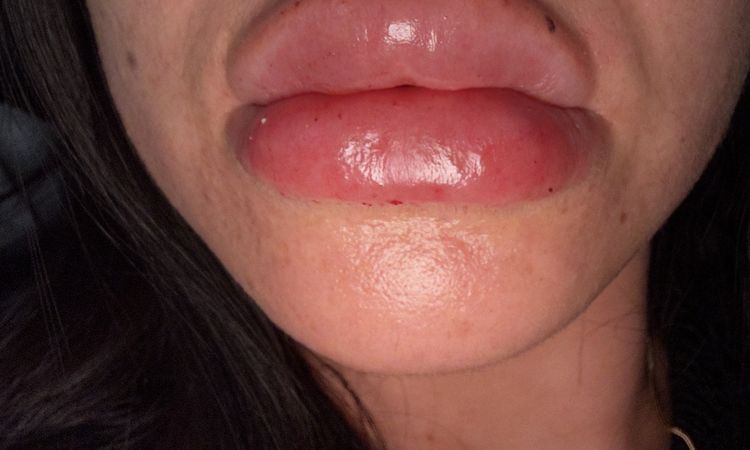 Labios con acido demasiada inflamación - 77304