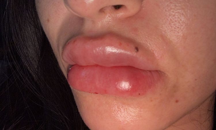 Labios con acido demasiada inflamación - 77305