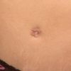 Cicatriz ombligo abdominoplastia