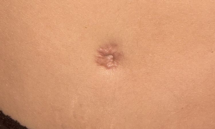 Cicatriz ombligo abdominoplastia - 77414
