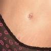 Cicatriz ombligo abdominoplastia