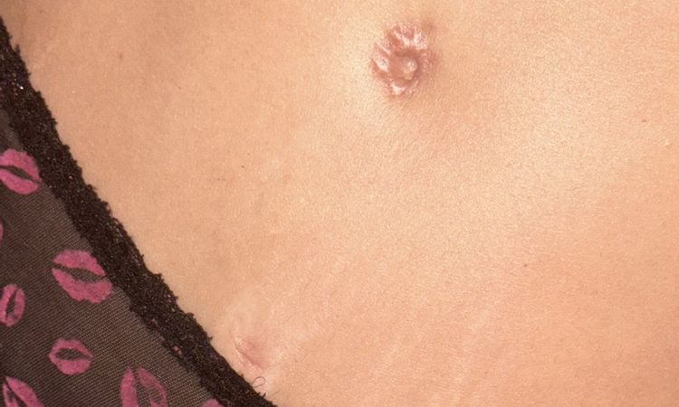 Cicatriz ombligo abdominoplastia - 77415