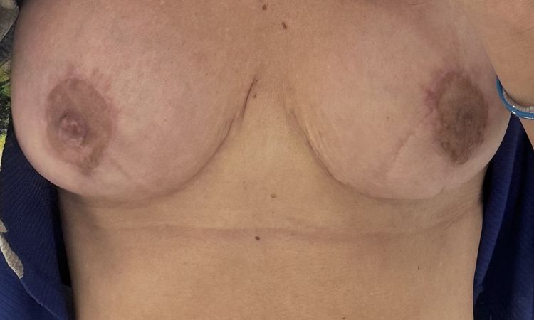 Mastopexia, implantes pequeños - 77600