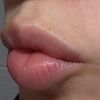 ¿Acido migrado labios?