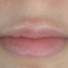 ¿Acido migrado labios?