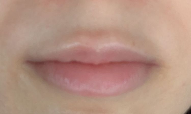 ¿Acido migrado labios? - 77656