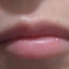 ¿Acido migrado labios?