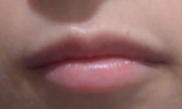 ¿Acido migrado labios? - 77657