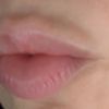 ¿Acido migrado labios?