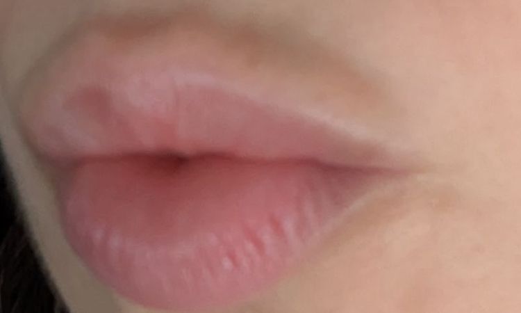 ¿Acido migrado labios? - 77658