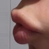 ¿Acido migrado labios? - 77659