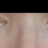 Resultado tras 3 meses operación de rinoseptoplastia con injerto