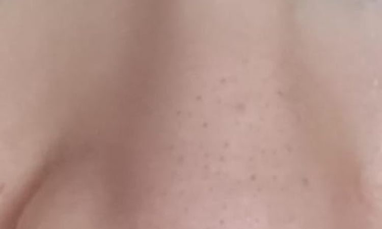 Resultado tras 3 meses operación de rinoseptoplastia con injerto - 77690