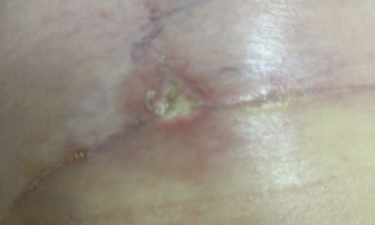 Cicatriz abierta mastopexia - 77700