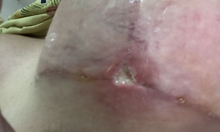 Cicatriz abierta mastopexia - 77701