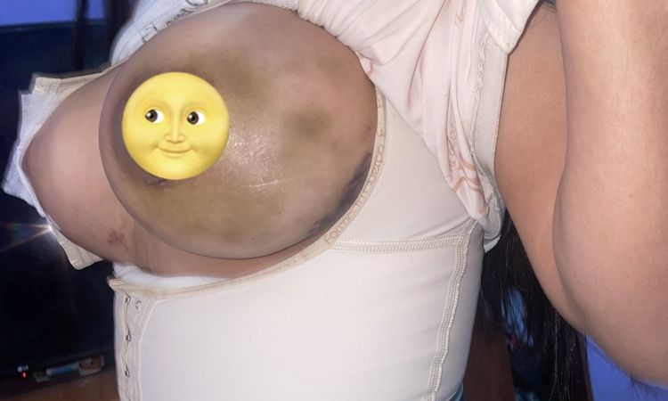 Hematoma en seno izquierdo tras aumento mamario - 77721