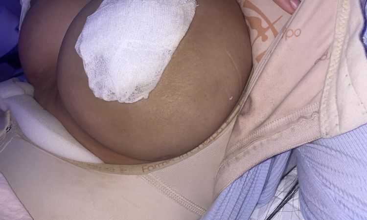 Hematoma en seno izquierdo tras aumento mamario - 77722