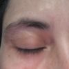 Blefaroplastia dolor después de 6 meses