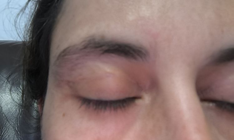 Blefaroplastia dolor después de 6 meses - 78092