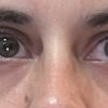 Blefaroplastia dolor después de 6 meses