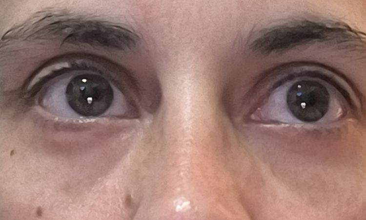 Blefaroplastia dolor después de 6 meses - 78093