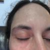 Blefaroplastia dolor después de 6 meses