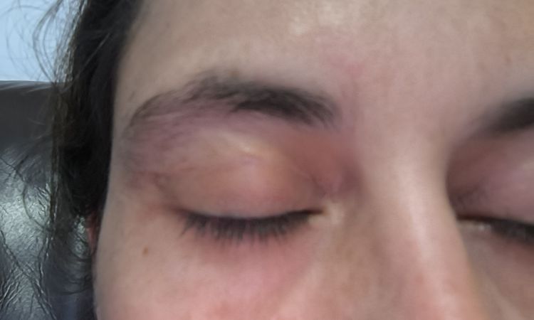 Blefaroplastia dolor después de 6 meses - 78094