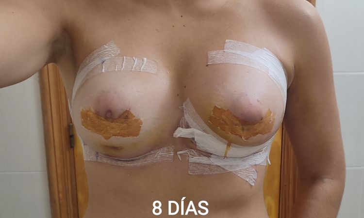 Hematoma en un pecho tras aumento - 78172