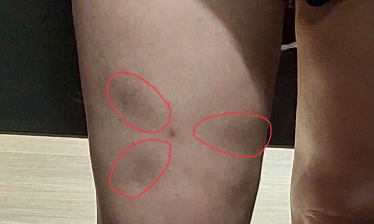 ¿En ecografía cutánea se puede ver una irregularidad post liposucción? - 78317