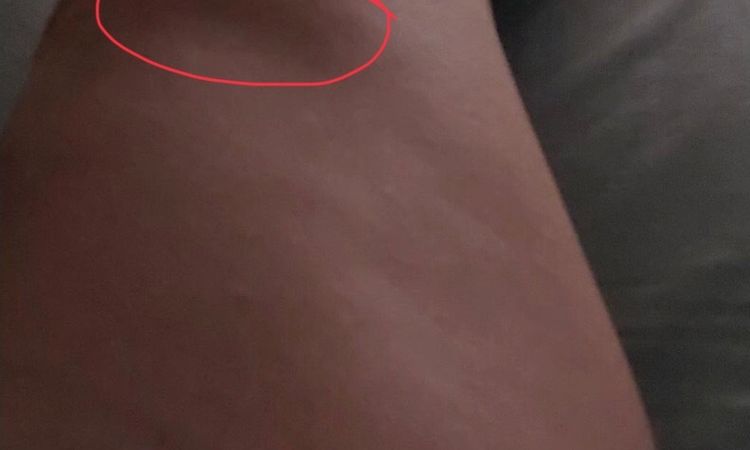 ¿En ecografía cutánea se puede ver una irregularidad post liposucción? - 78323