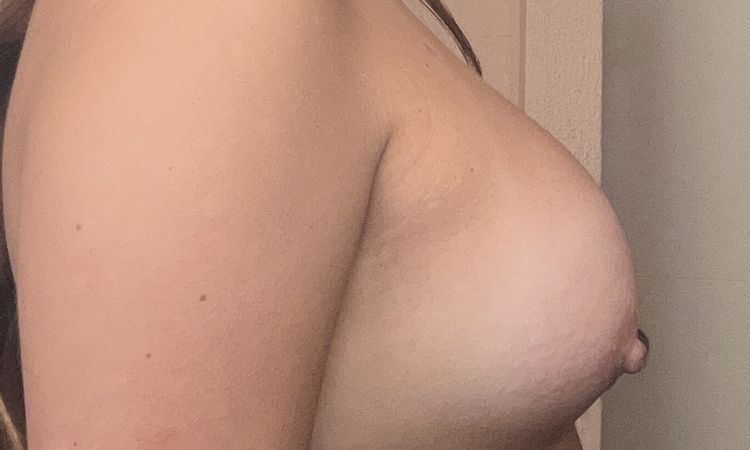 Pezones muy abajo después de mamoplastia de aumento - 78381