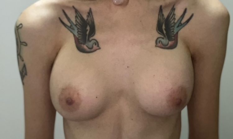 3 meses operada y molestias tras entrenamiento - 78552