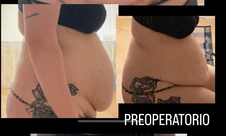 Necesito segundas opiniones sobre mi abdominoplastia, estoy muy triste… - 78567