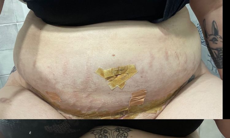 Necesito segundas opiniones sobre mi abdominoplastia, estoy muy triste… - 78568