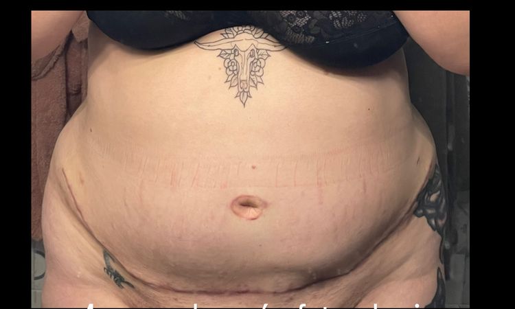Necesito segundas opiniones sobre mi abdominoplastia, estoy muy triste… - 78569