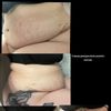 Necesito segundas opiniones sobre mi abdominoplastia, estoy muy triste…