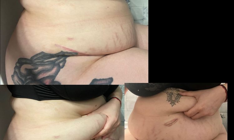 Necesito segundas opiniones sobre mi abdominoplastia, estoy muy triste… - 78570