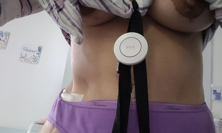 Mi lado derecho se ve como cortado después de abdominoplastia - 78703