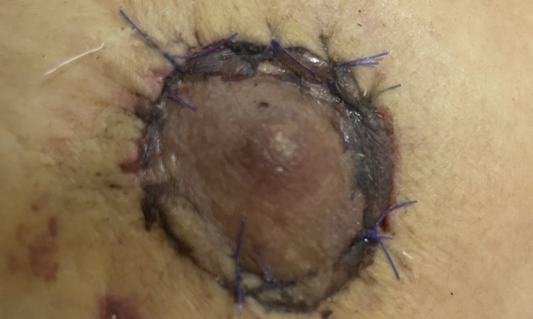 ¿Mi cicatriz de mastopexia tiene necrosis? - 78806