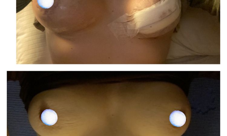 ¿Mastopexia en T invertida mal realizada? - 78815