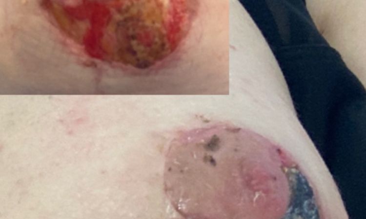 ¿Mastopexia en T invertida mal realizada? - 78816