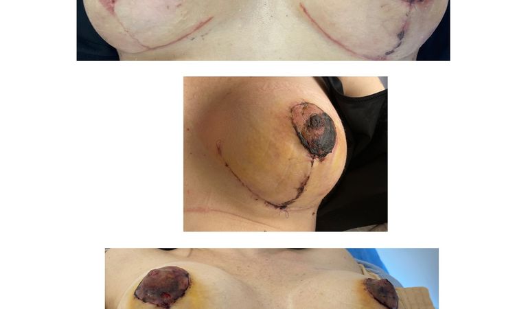 ¿Mastopexia en T invertida mal realizada? - 78817