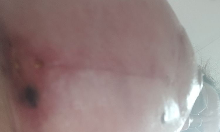 Problemas mastopexia a las 6 semanas - 78858