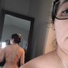 Irregularidades en espalda alta después de liposucción