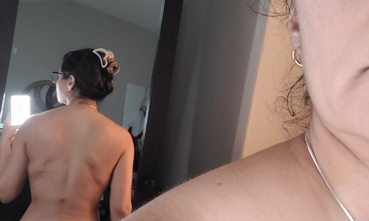Irregularidades en espalda alta después de liposucción - 79003