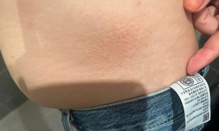 Hemosiderina por sculptra en glúteos, ¿es posible? - 79067