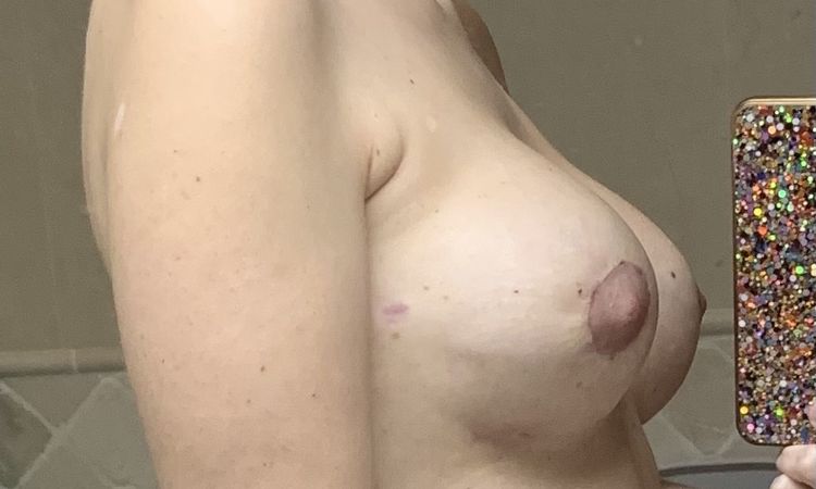 Mastopexia periareolar + recambio prótesis - 79260