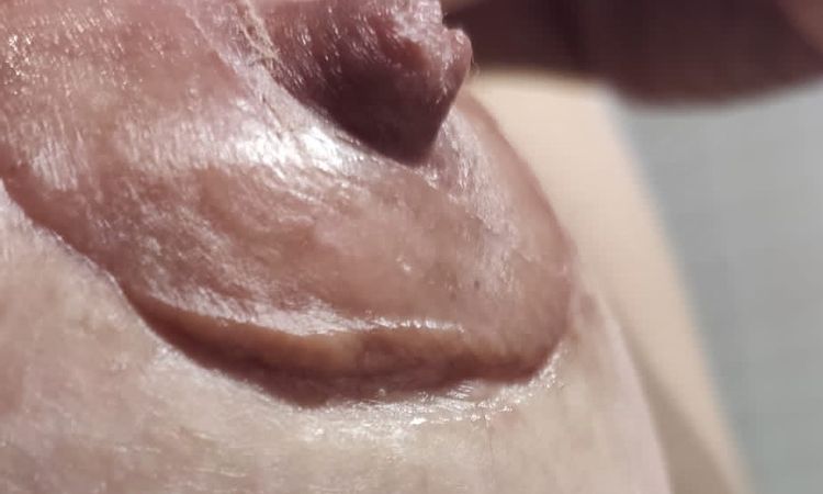 Zona elevada Mastopexia periaerolar - 79466
