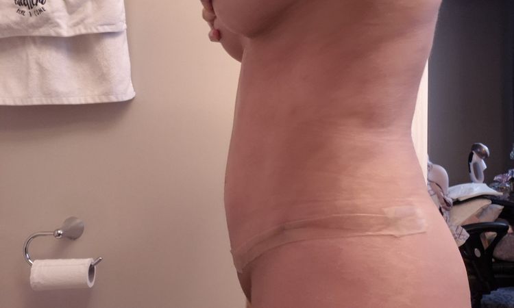 Area del ombligo inflamada tras abdominoplastia - 79504