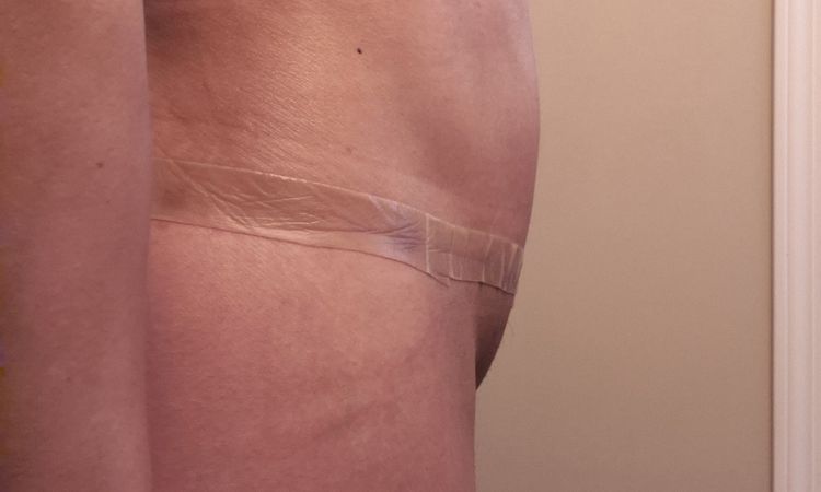Area del ombligo inflamada tras abdominoplastia - 79505